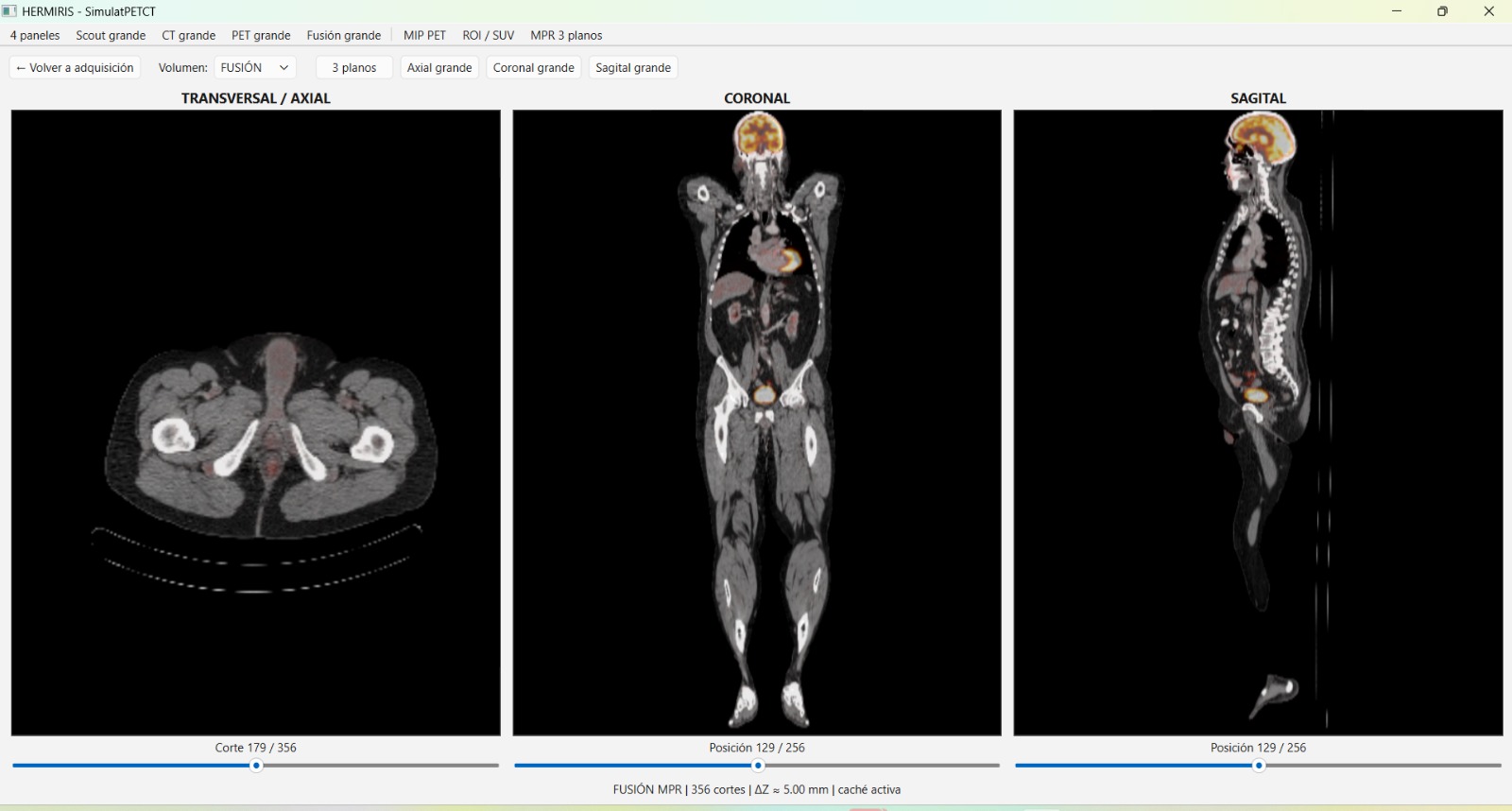 SimulatPETCT
